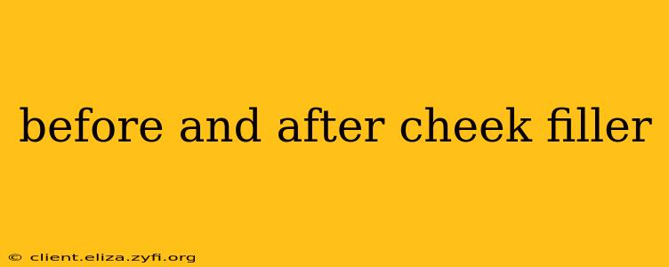 before and after cheek filler
