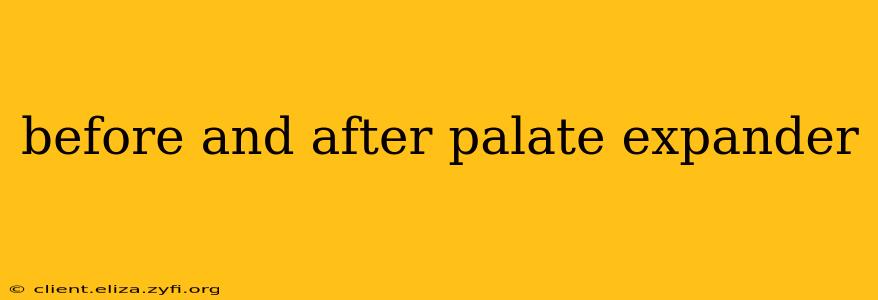 before and after palate expander