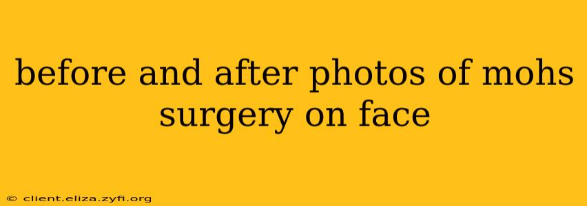 before and after photos of mohs surgery on face