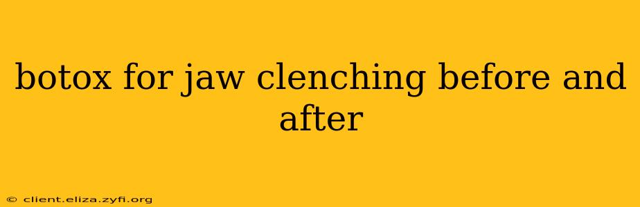 botox for jaw clenching before and after