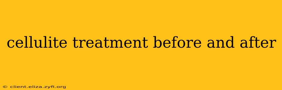 cellulite treatment before and after