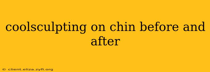 coolsculpting on chin before and after