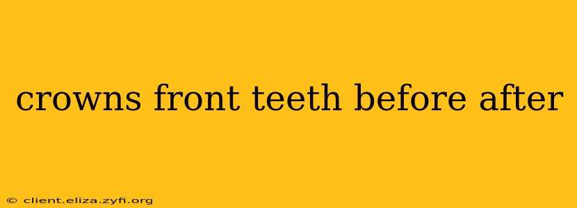 crowns front teeth before after