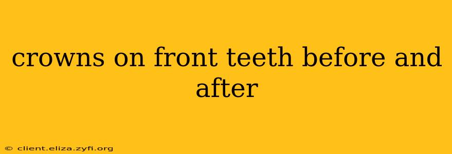 crowns on front teeth before and after