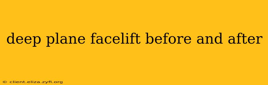 deep plane facelift before and after