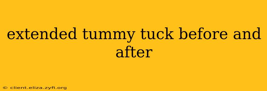 extended tummy tuck before and after