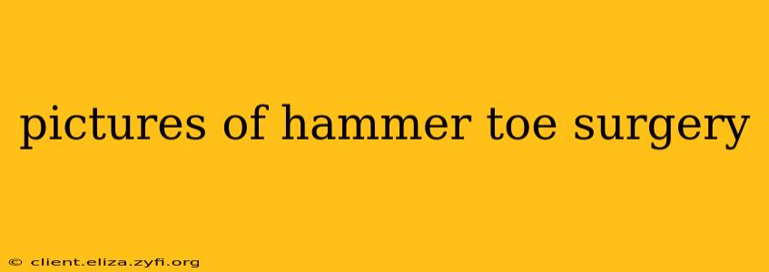 pictures of hammer toe surgery