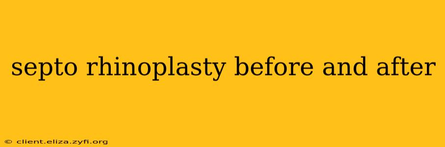 septo rhinoplasty before and after
