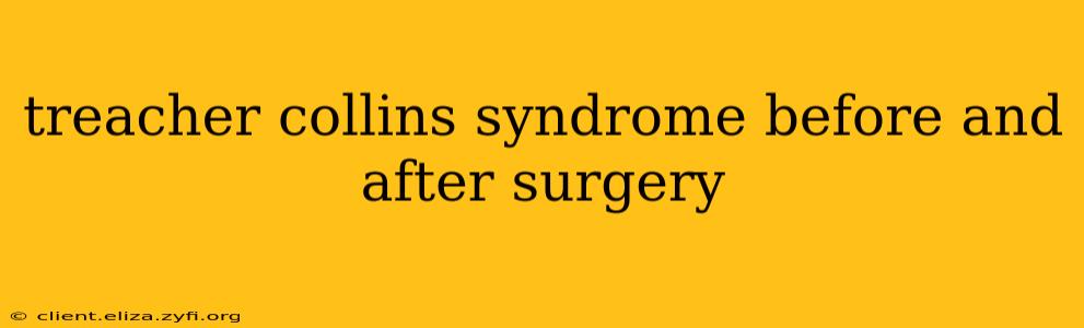 treacher collins syndrome before and after surgery