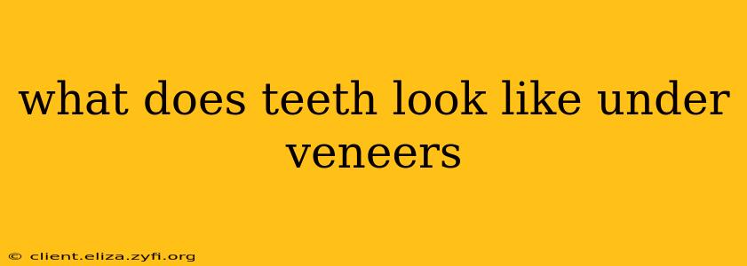 what does teeth look like under veneers
